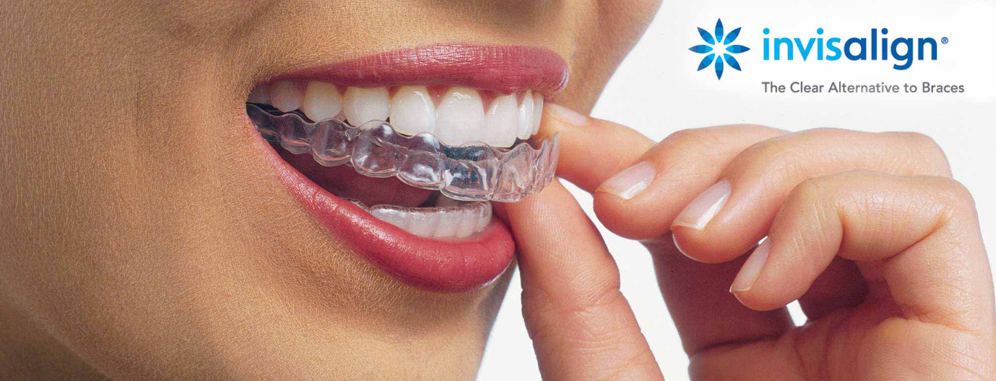 Invisalign Cost - TriCity Orthodontics